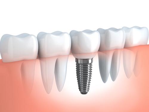 dental implants high point