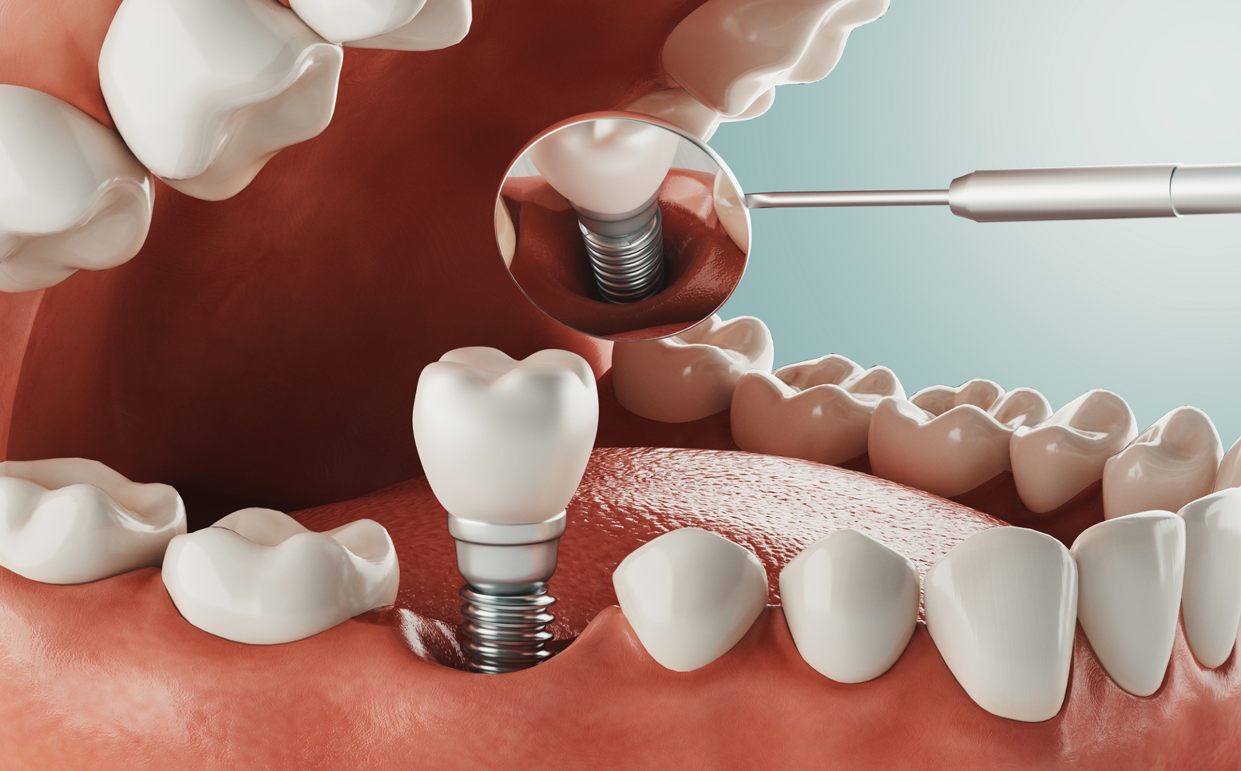 Illustration showing a dental implant replacing a missing tooth