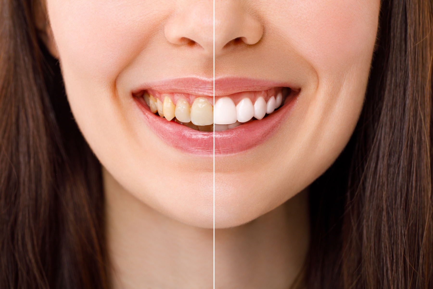 Before-and-after comparison showing the results of professional teeth whitening