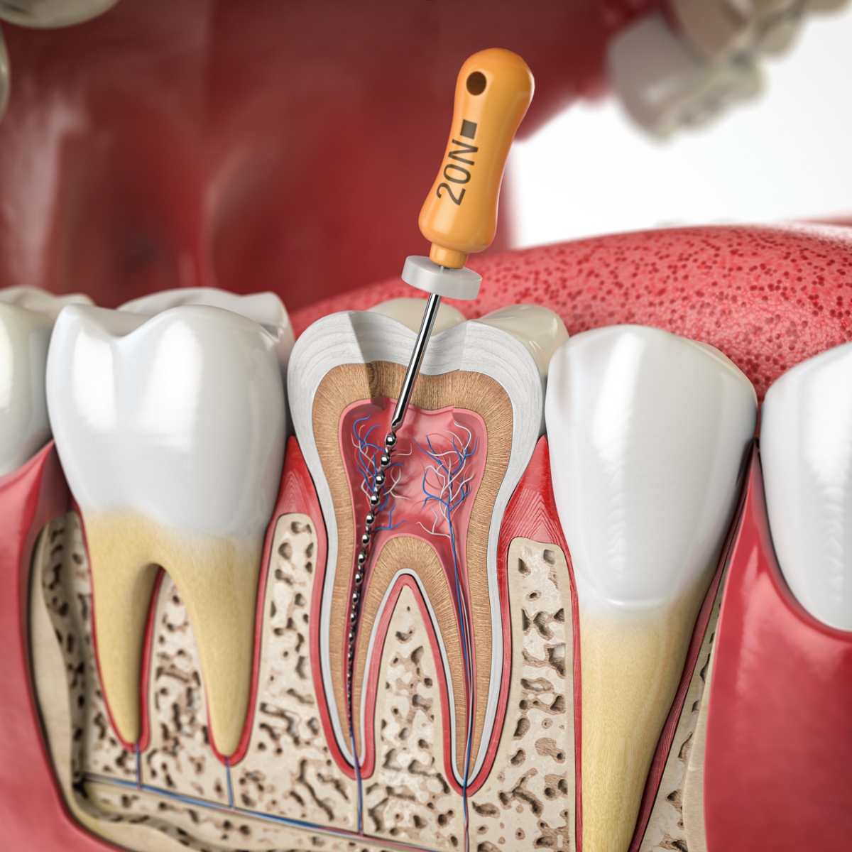 Illustration showing the inside of a tooth during root canal treatment