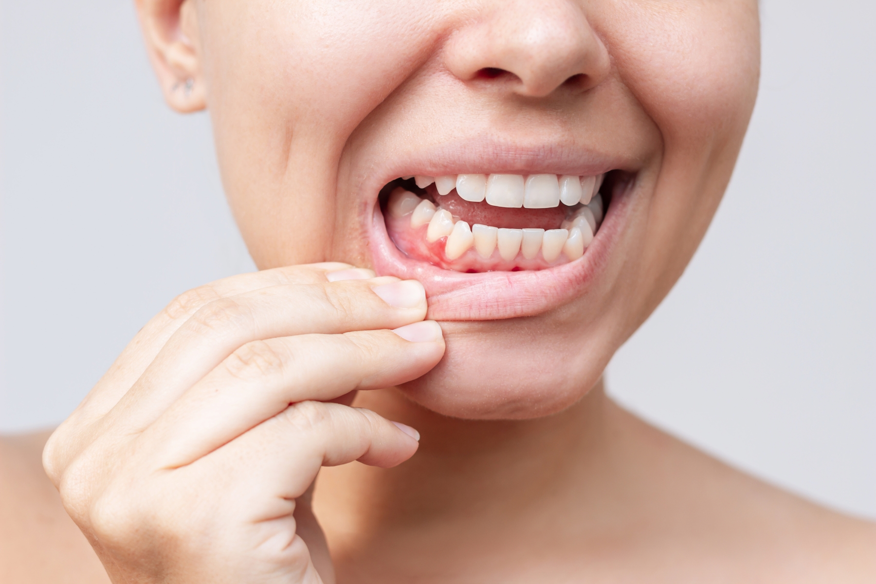 Woman showing signs of gum irritation and inflammation