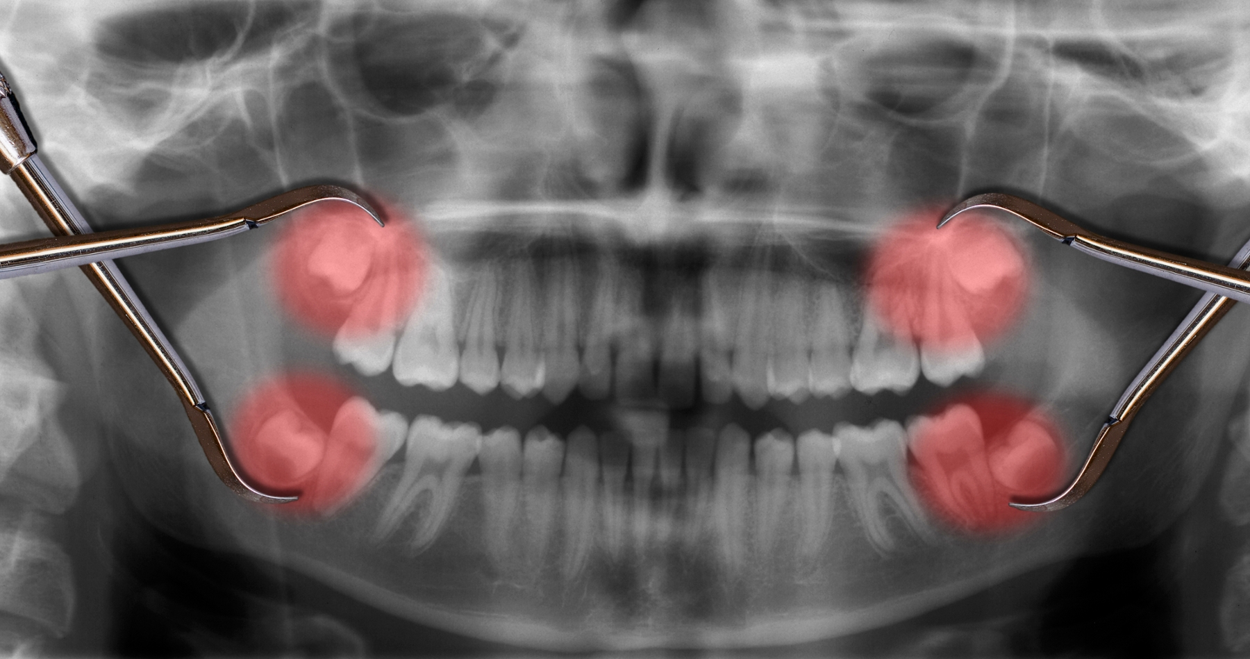 x-ray highlighting the wisdom teeth that need to be extracted in high point, nc