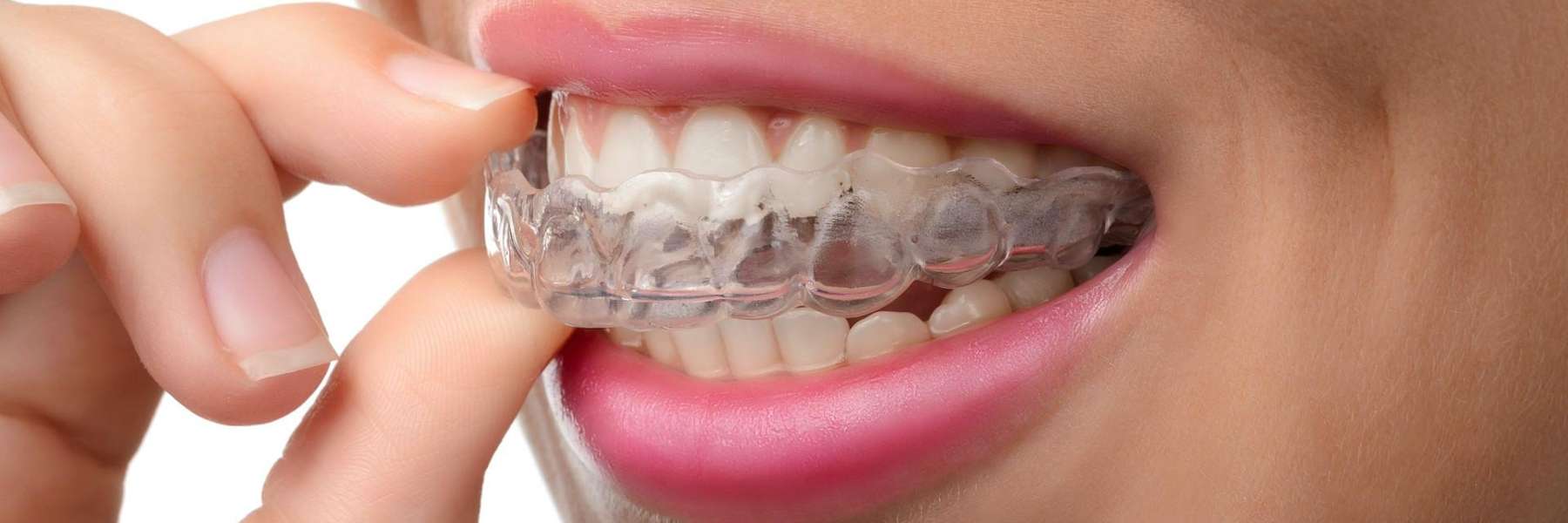 Invisalign High Point, NC