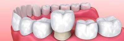 An Illustration of a dental crown in High Point, NC
