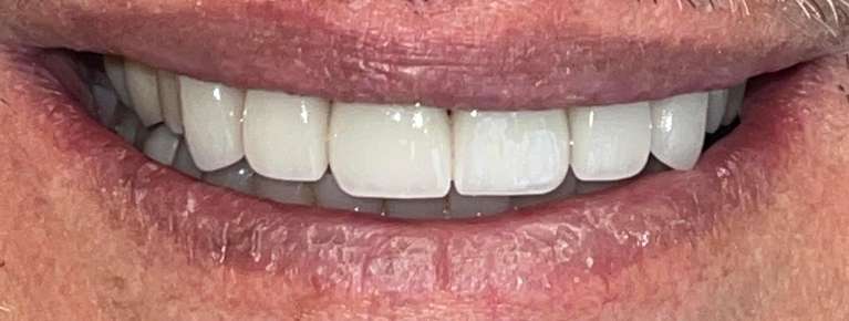 Cosmetic-Dentistry-After-Image