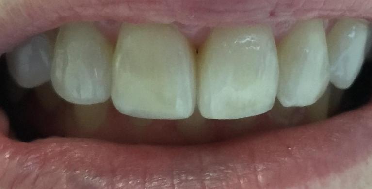 Invisalign-After-Image