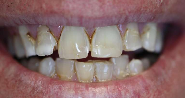 Full-Mouth-Reconstruction-Before-Image