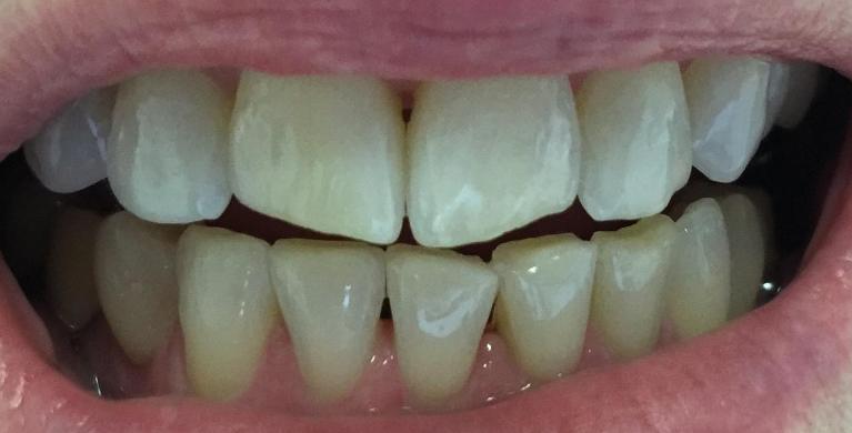 Invisalign-Before-Image